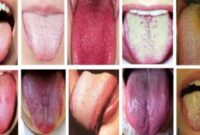 Diagnosis Penyakit Lewat Lidah