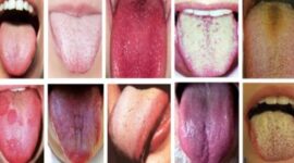 Diagnosis Penyakit Lewat Lidah